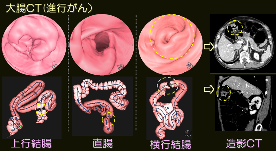 大腸進行がんの画像