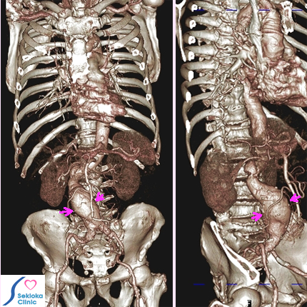 腹部大動脈瘤MDCT画像