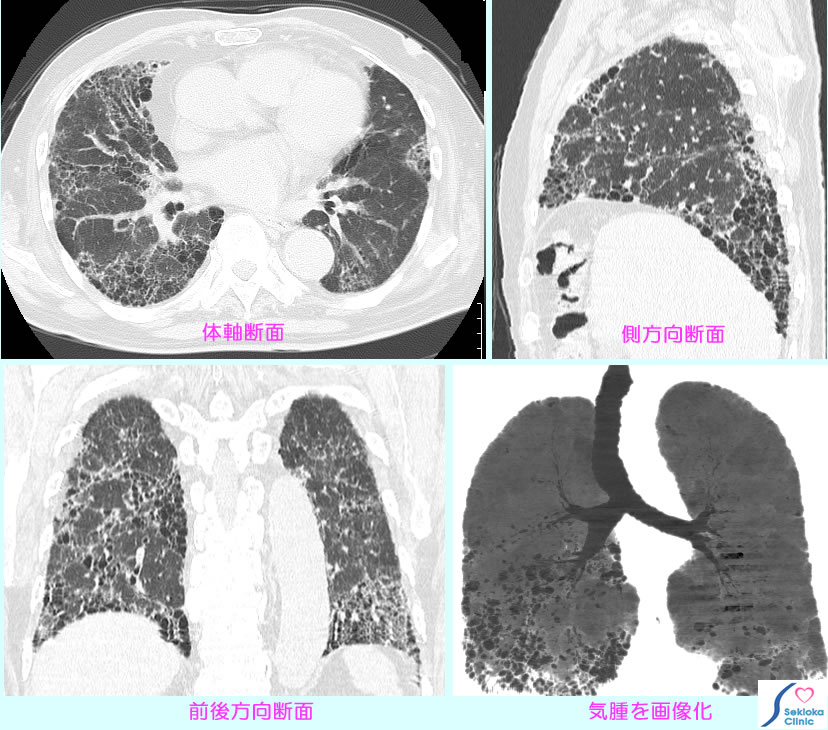 肺線維症　CT画像