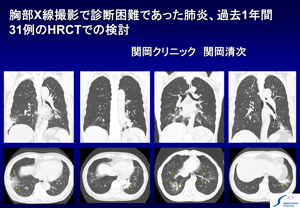 肺炎診断X線撮影とMDCTの比較